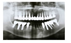 インプラント治療レントゲン